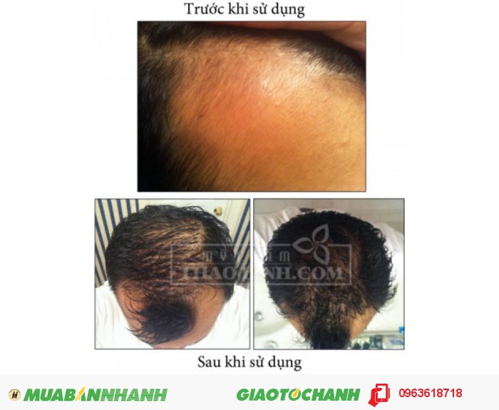 Thành phần quan trọng nhất trong NuHair Thinning Hair Serum là Hà Thủ Ô Đỏ một loại thảo dược tự nhiên có tên khoa học là Polygonum multiflorum được sử dụng trong y học cổ truyền Trung Quốc như một loại thuốc bổ và một phương thuốc chống lão hóa, đặc biệt đối với rụng tóc và làm chậm quá già tóc., 3