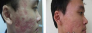 Trị sẹo Rỗ Ngoc Trinh Quận 6