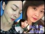 Kem trị mụn