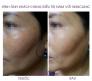 Trị nám tàn nhang bằng laser yag