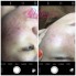 Trị Mụn Tận Gốc Thủ Đức