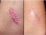 Trị sẹo lồi, lõm, rạn da của Nga