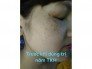 Đặc trị nám TRẦN KIM HUYỀN