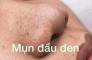 Kem mụn hiệu quả