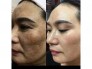 Hana Melasma Mờ Nám, tàn nhang