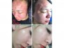 Thanh dược siêu trị tất cả các loại mụn