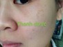 Mỹ phẩm Thanh dược đặc trị tàn nhang