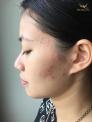 Gel trị mụn