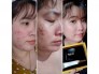 Combo đặc trị mụn Queenie skin