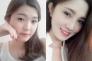 Bấm mí mắt giá bao nhiêu tiền