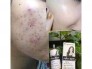 Trị mụn, nám và tàn nhang