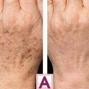 Kem Achromin đặc trị nám tàn nhan dưỡng trắng da 45ml