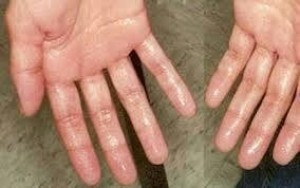 Mồ hôi tay chân nách khó chịu trong thời tiết nóng bức,phải làm sao