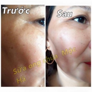 Sản phẩm trị nám