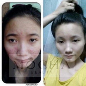 Bộ trị mụn Đông y
