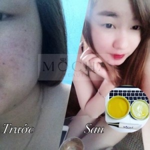 Bộ trị mụn Đông y