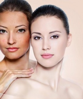 Điều trị nám dermajector -cách trị nám d