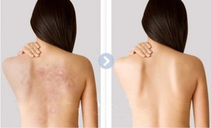 Trị Mụn Thâm Ở Lưng Hiệu Quả