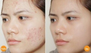 Cao Actiso Hà Giang trị mụn dứt điểm tận gốc, thanh nhiệt mát gan, giải độc cơ thể
