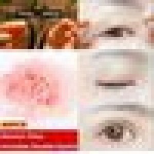 2 Vỉ chỉ kích mí 104 sợi