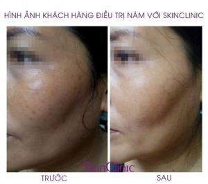 điều tri nam da
