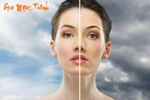 Trị nám tàn nhang bằng laser