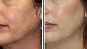 Trị nám tàn nhang bằng laser