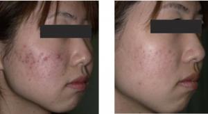 Lăn kim trị sẹo lõm tế bào gốc