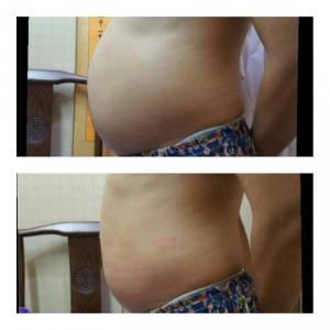 Giảm Mỡ Bụng Công Nghệ RF quận 6