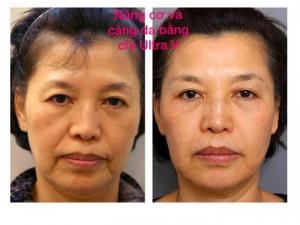Nâng cơ bằng chỉ Ultra vlift