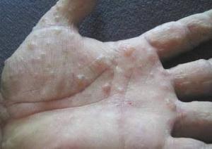 Đặc trị nấm da Trần Mười