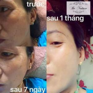 Liệu trình trị nám, tàn nhang be nature