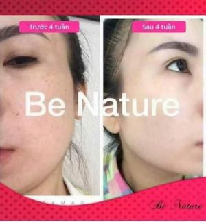 Liệu trình trị nám, tàn nhang be nature