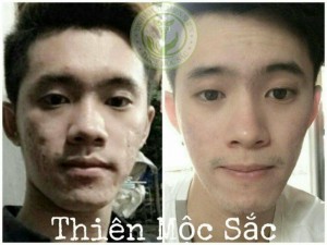 Tái tạo da trị mụn tận gốc Thiên Mộc Sắc