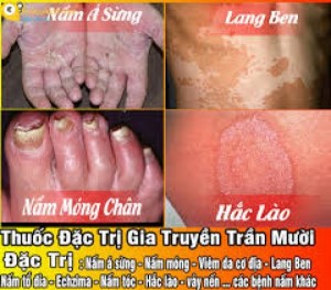 Chuyên đặc trị Nấm Da- Hác Lào- Lang Ben dứt điểm không tái phát