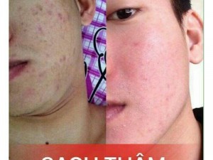 Serum JQA trị mụn trắng da