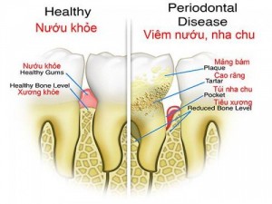 Nước súc miệng đông y chữa mọi bệnh răng miệng, làm trắng sáng sau 2 tuần