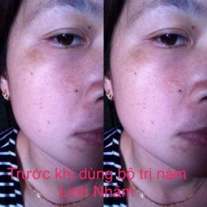 Kem trị nám Linh Nhâm