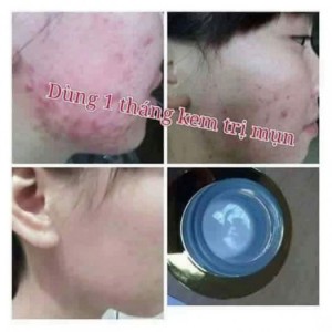 Kem trị mụn Linh Nhâm