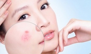 Diệt Mụn Tận Gốc Vĩnh Viễn Chỉ Sau 2 Tuần Xuất Xứ Nhật Bản!
