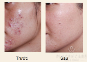 Diệt Mụn Tận Gốc Vĩnh Viễn Chỉ Sau 2 Tuần Xuất Xứ Nhật Bản!
