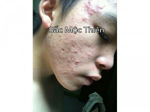 Trị mụn thâm nám tàn nhang tận gốc