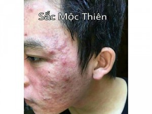 Trị mụn thâm nám tàn nhang tận gốc
