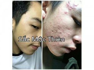 Trị mụn thâm nám tàn nhang tận gốc