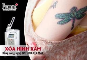 Xoá hình xăm không sẹo quận 6