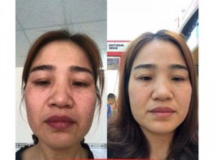 Sản phẩm trị mụn thâm nám tàn nhang sẹo rỗ