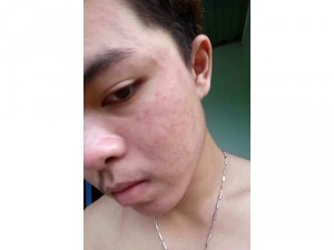 Sản phẩm trị mụn thâm nám tàn nhang sẹo rỗ
