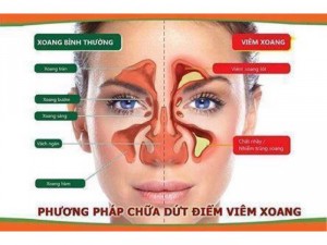 Hỗ trợ cho người bị viêm xoang