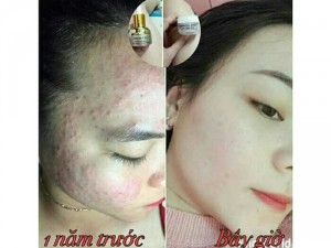 Đặc Trị Mụn Spl_Tiêu Diệt Các Loại Mụn