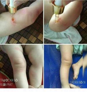 Serum Thảo Dược Kiều